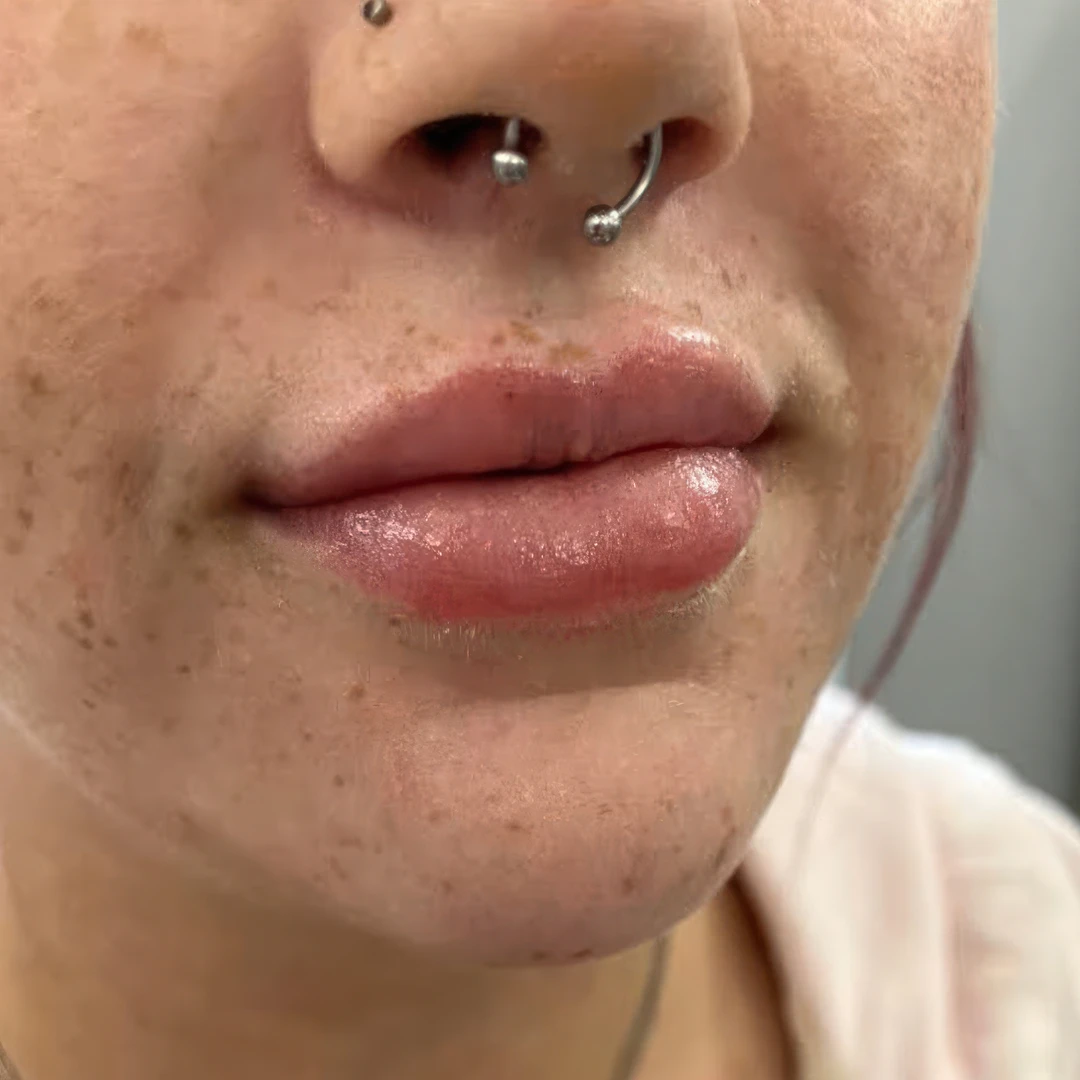 Lip Disolving. Contact me for advice.